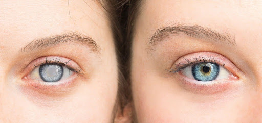 Post-Operative Care for Cataract Surgery: 7 Tips for a Smooth Recovery